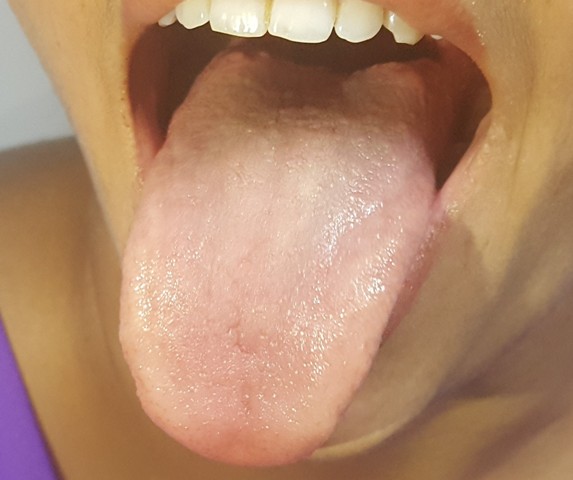 Examination of dorsum of tongue