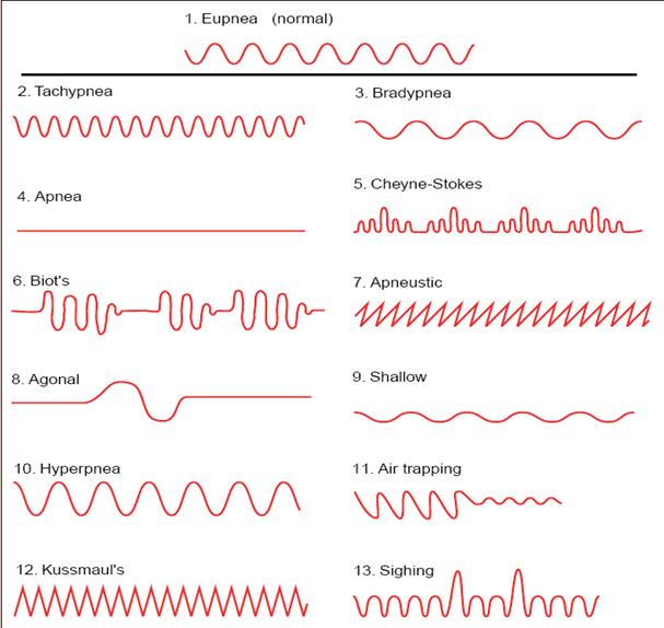 Abnormal Breathing Patterns