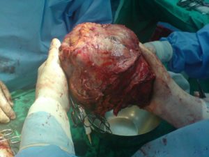 Liver tumor after removal