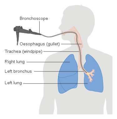 Bronchoalveolar Lavage Bal Procedure Indications And Diagnostic Tests Medcaretips Com