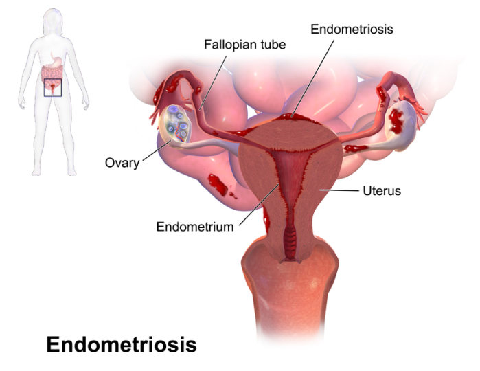 Endometriosis sites image