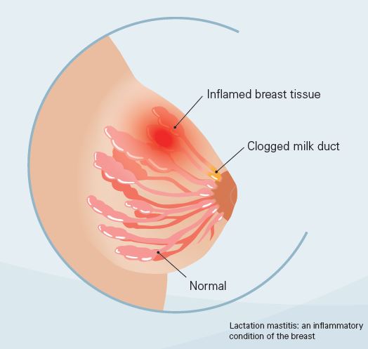 mastitis