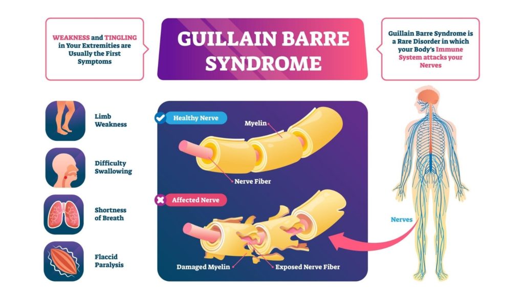 guillain-barre-syndrome